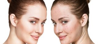 kurse zur laser haarentfernung hannover Soft Skin Hannover Nordstadt | dauerhafte Haarentfernung | Hydrofacial | Akne Behandlung | Anti Aging | Microneedling